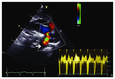 Two Dimension Echocardiographic Recording Of The Distal Portion Of The