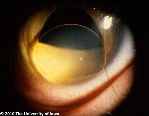 Marfan Syndrome. EyeRounds.org - Ophthalmology - The University of Iowa