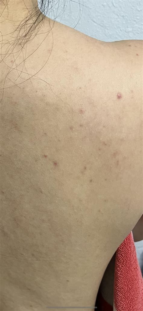 [skin Concerns] Backne And Chest Acne How To Make It Better R Skincareaddiction