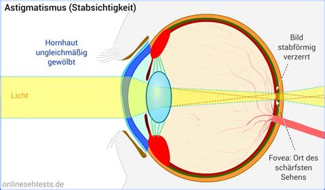 Astigmatismus Stabsichtigkeit