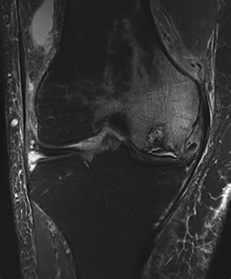 Reliable Outcomes And Survivorship Of Unicompartmental Knee