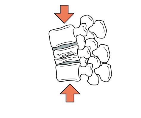 腰痛原因の違い：非特異的腰痛と特異的腰痛の解説｜長谷川瑞樹地域で頑張る理学療法士