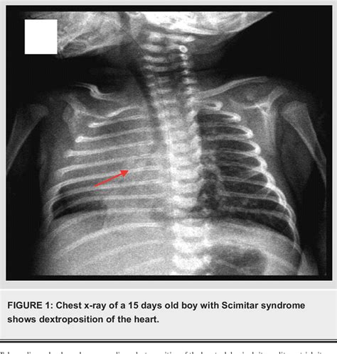 Figure 1 From Respiratory Distress In Neonate With Scimitar Syndrome Semantic Scholar