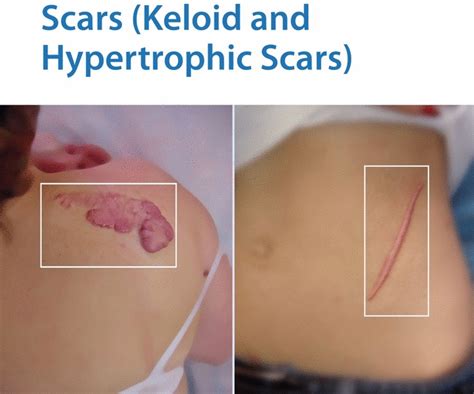 Hypertrophic Scar Vs Keloid