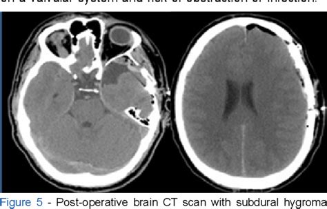 Figure 5 From Arachnoid Cyst Spontaneous Rupture Semantic Scholar