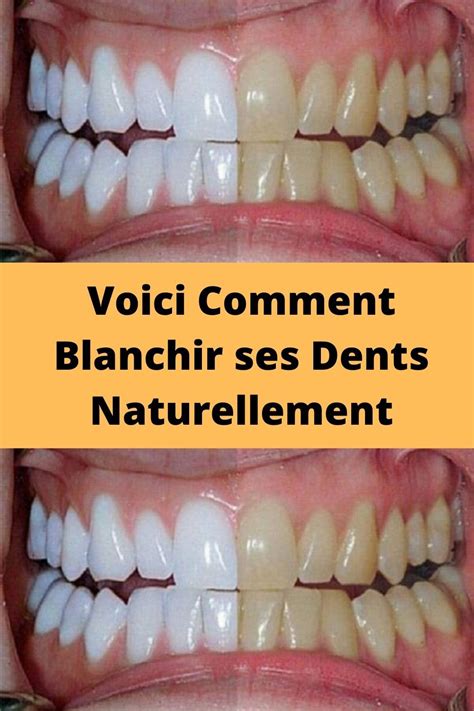 Voici Comment Blanchir Ses Dents Naturellement En 2022 Blanchir Les Dents Naturellement