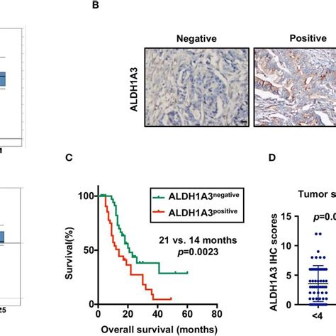 High Expression Of ALDH1A3 Is Correlated With Poor Prognosis In PDAC