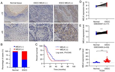 Melk Predicts Poor Prognosis And Promotes Metastasis In Esophageal