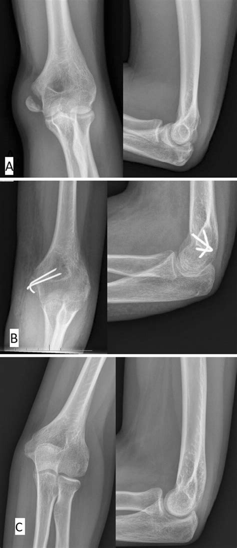 A Thirteen Year Old Girl With Isolated Medial Epicondyle Fracture