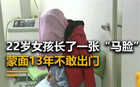 22岁女孩长了一张“马脸”，蒙面13年不敢出门，医生看完直呼可怕 哔哩哔哩