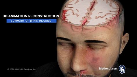 Head Trauma Animation Depicts Scope Of Brain Injuries Ensued After Bar