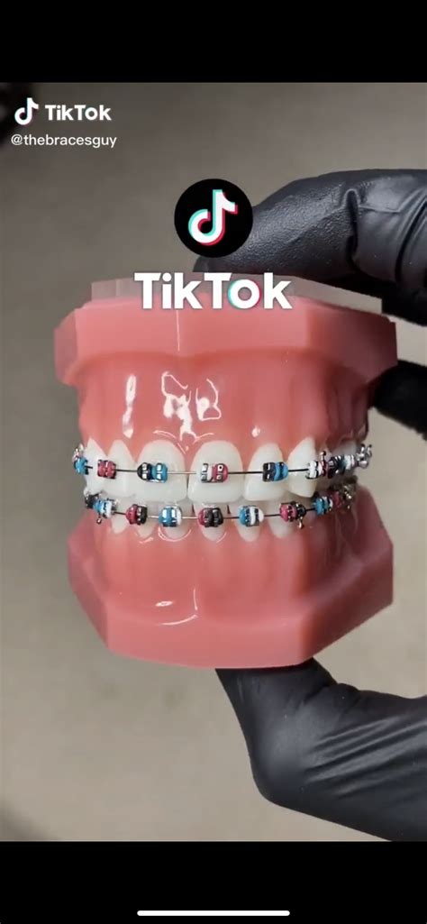 Cute Braces Colors