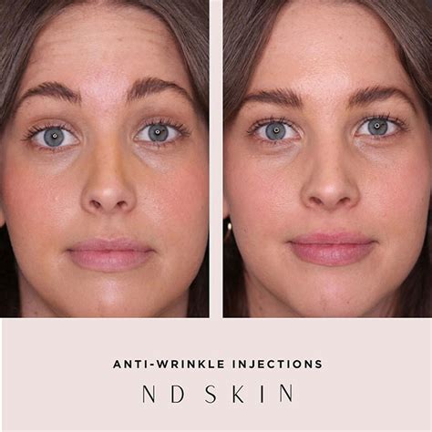 Anti Wrinkle Injections Photo Gallery - ND Skin Clinic