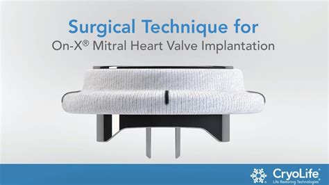 Surgical Technique For On X® Mitral Heart Valve Implantation Artivion