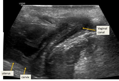 [figure Translabial Ultrasound Of 2 Year ] Statpearls Ncbi Bookshelf