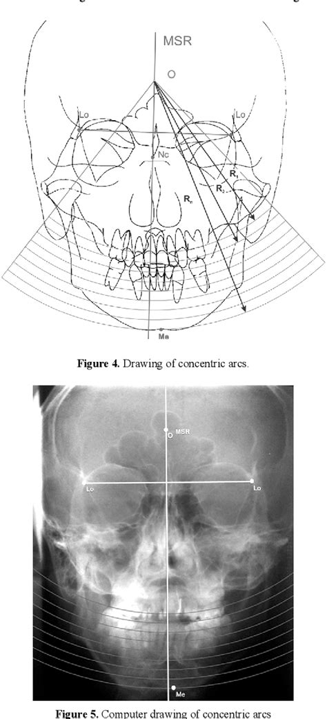 Table From Otorhinolaryngology Head And Neck Surgery Cephalometric