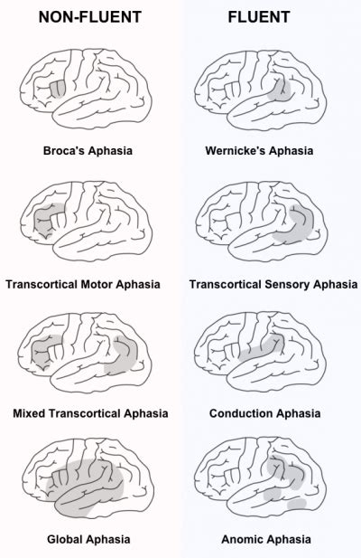 Transcortical Motor Aphasia Lesion Site | Webmotor.org