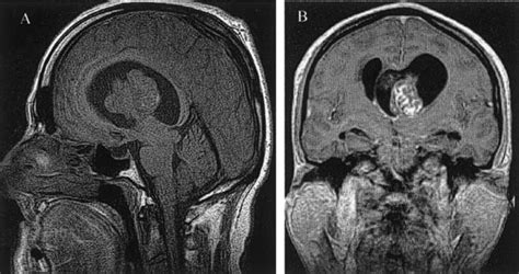 A Sagittal Pre Contrast Enhanced And B Coronal Contrast Enhanced