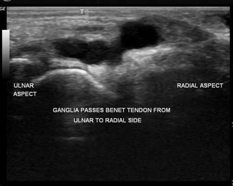 Ganglion Cyst On Wrist Ultrasound