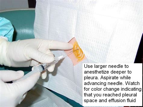 Clinical Notes Thoracentesis A Step By Step Procedure Guide With Photos