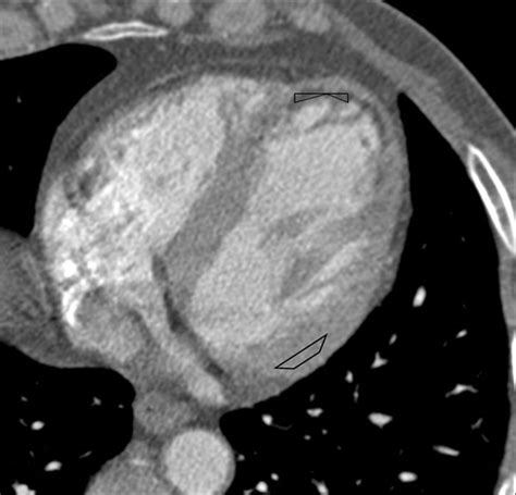 Ct Detection Of Subendocardial Fat In Myocardial Infarction Ajr