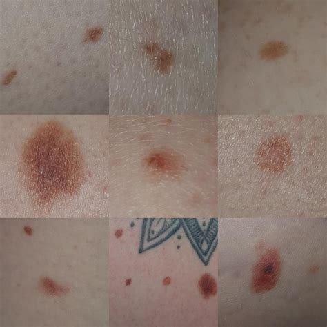 Dysplastic Nevus R Dermatologyquestions