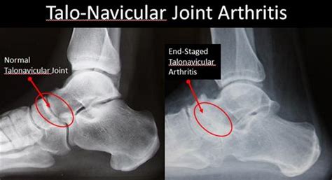 Rheumatoid Arthritis - Talonavicular Joint - FootEducation