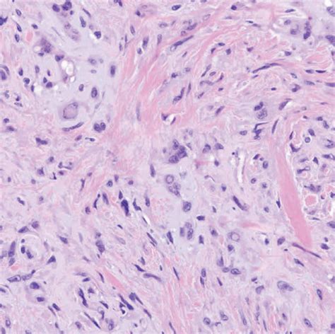 (a) Biopsy of the parotid gland revealed a neoplasm comprised of ...