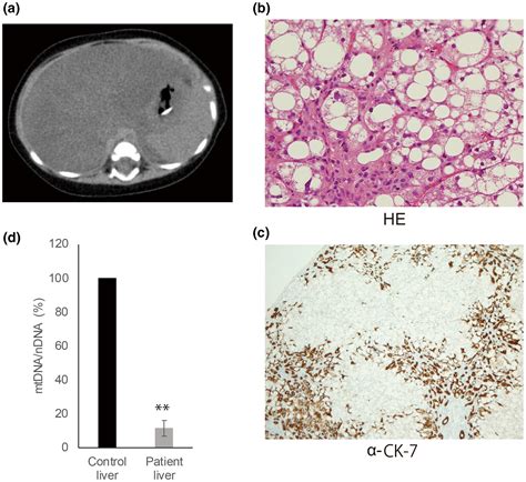 A Novel Homozygous Variant In MICOS13 QIL1 Causes Hepatoencephalopathy