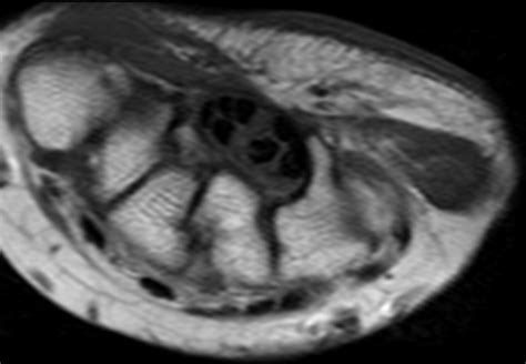 Carpal Tunnel Syndrome-MRI - Sumer's Radiology Blog