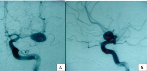 Preoperative Cerebral Angiography Findings A AP And B Lateral