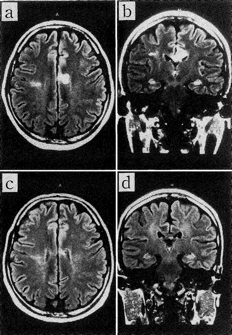 Table 1 From Primary Antiphospholipid Syndrome Presenting With Cerebral