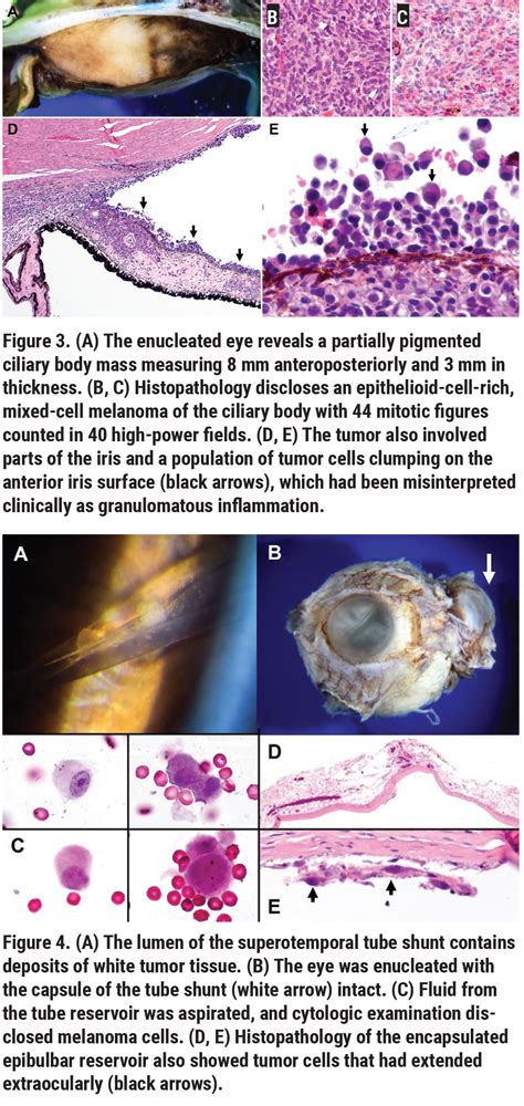 Ciliary Body Histology