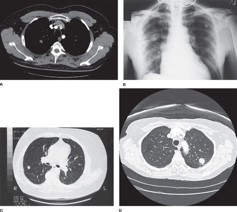 What Does A Lung Nodule Look Like