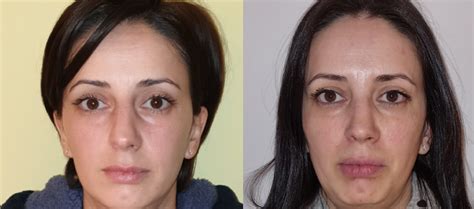 Inainte Si Dupa Before And After Rinoplastie