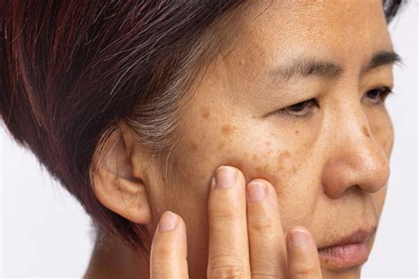 Melasma What Are The Best Treatments Harvard Health