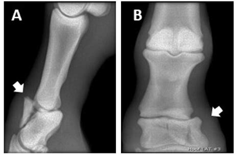 Im Genes De Fracturas Conminutas