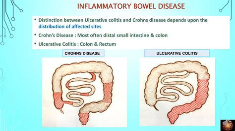 Inflammatory Bowel Disease Pathogenesis Ppt