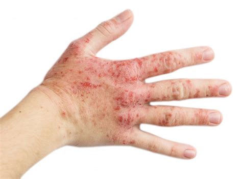 Eczema Rash On Hands