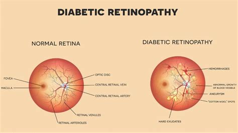 Cloudy Lens: Symptoms, Associated Diseases, and Treatment | 1MD Nutrition™