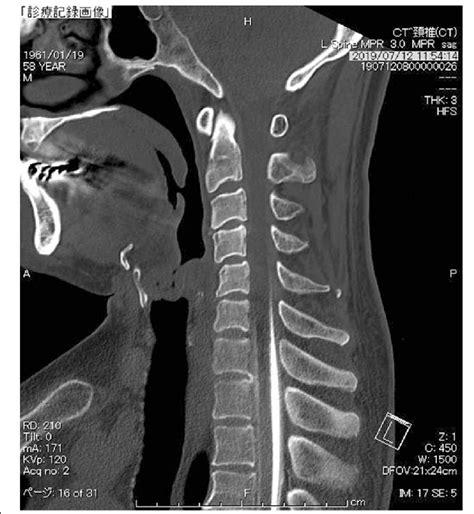 Csf Blockage Detected By Computed Tomography Ct Myelogram A Saggital Download Scientific