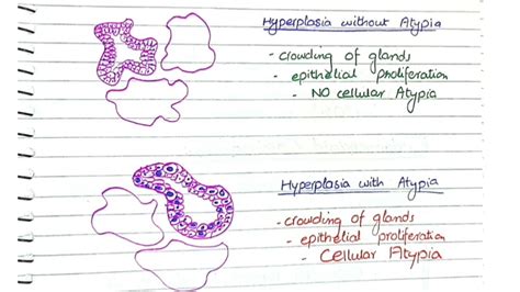 Endometrial Hyperplasia Pathology Youtube