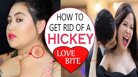 How To Get Rid Of A Hickey Fast Home Remedies For Love Bite Removal