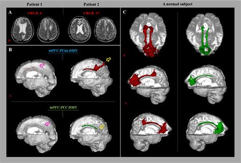 Relationship Between The Consciousness State And The Default Mode