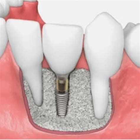 Dental bone graft recovery, LuxDen Dental Center