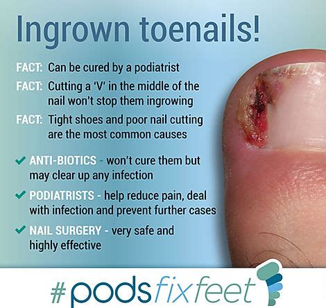 Ingrown Toenail Surgery: When It's Necessary - Ask The Nurse Expert