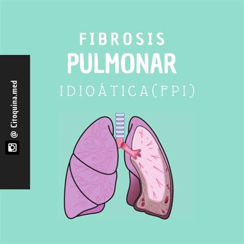 Fibrosis Pulmonar Idiop Tica Citoquina Cc Udocz