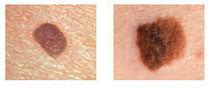 Ugc Utrera Sur C Mo Diferenciar Un Lunar O Nevus De Un Melanoma