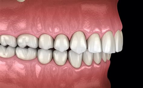 Common Orthodontic Problems Terrana Orthodontics