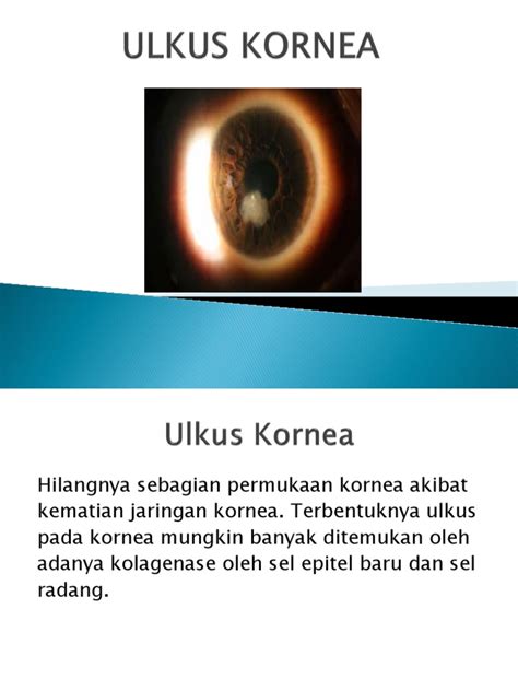 Ulkus Kornea Pdf